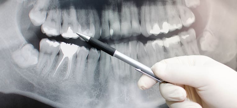 Asheville Tooth Extraction
