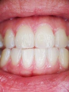 teeth-887338_960_720
