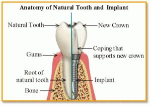 asheville dental implants