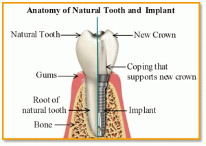 Dental Implant Services Asheville NC asheville dental implants