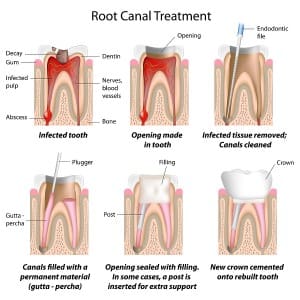 this process enables you to keep your natural tooth while at the same time clearing the infection and filling the cavity with a sealant in order to further