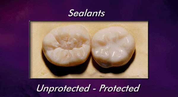 sealants, protected and unprotected Dental Sealants Asheville