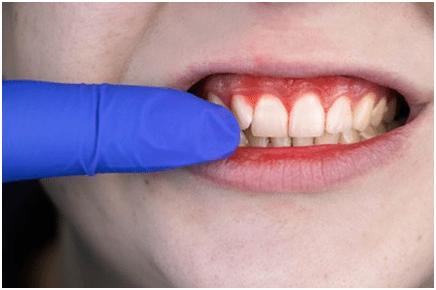 Can Gum Disease Be Reversed