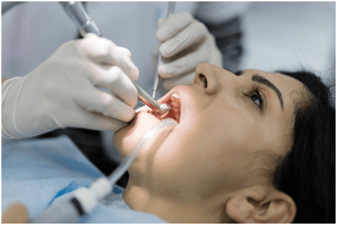 5 Myths about Root Canal Therapy