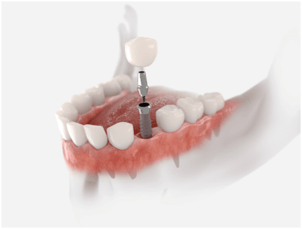 Dental Implants vs. Dentures: Which Are Better Tooth Replacements?