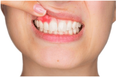 Why Are My Gums Receding? And Other Periodontal FAQs