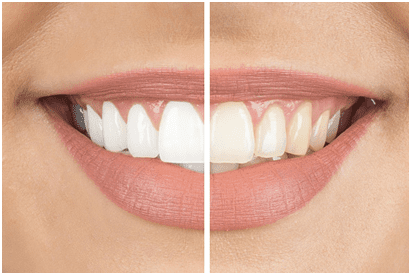 Can a Professional Teeth Whitening Help My Smile?