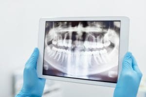 Dental X-Rays Asheville
