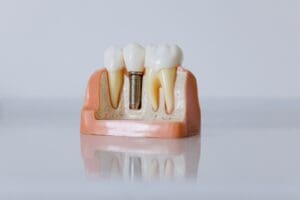 dental implants Asheville