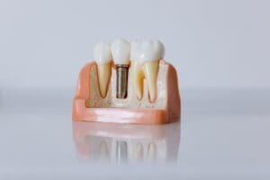 dental implants in Asheville