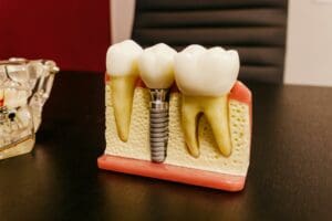 Benefits of dental implants